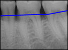 Image of normal bone levels