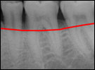 Image of moderate bone levels