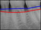 Image of moderate bone levels