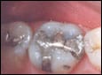 Image of molars with fillings