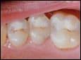 Image of molars
