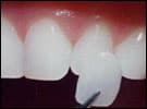 Image of veneers before