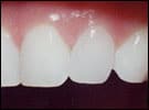 Image of veneers after