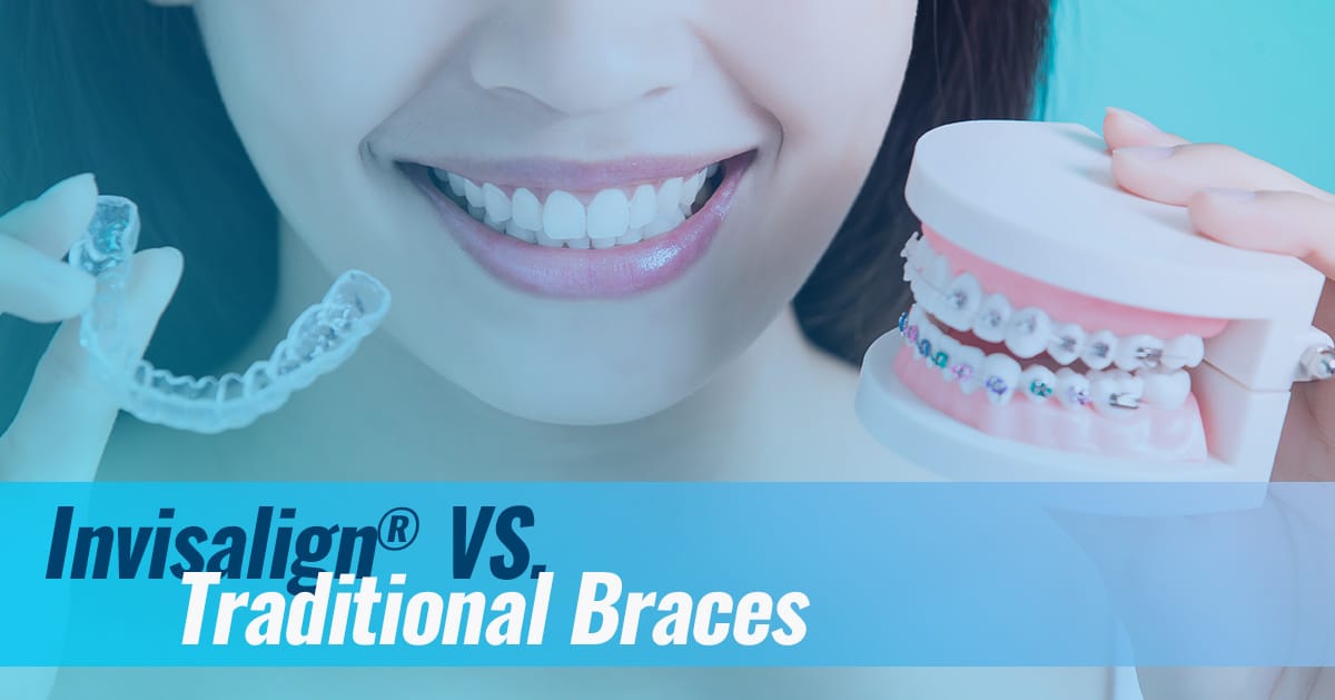 Invisalign