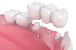 Dental implant models displayed on pink platform showing tooth replacement prosthetics and components.