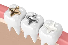 Three white tooth models showing different orthodontic bracket options in gold, silver, and clear finishes.