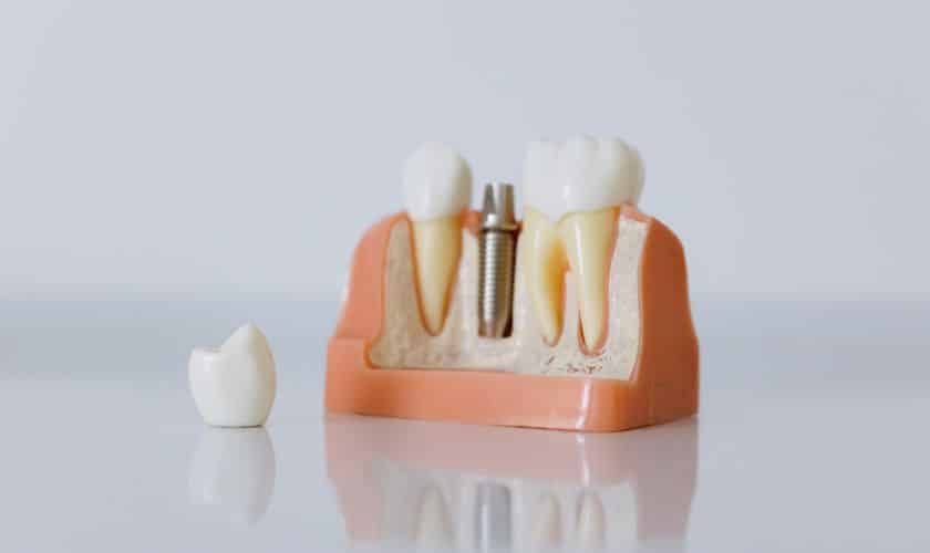 Comfortable dental implant procedure