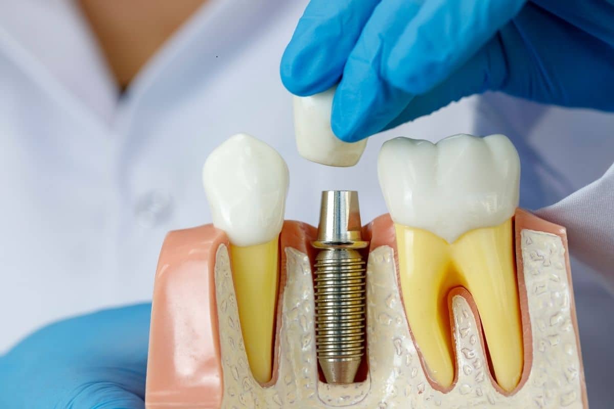 Dental Implants in Seattle