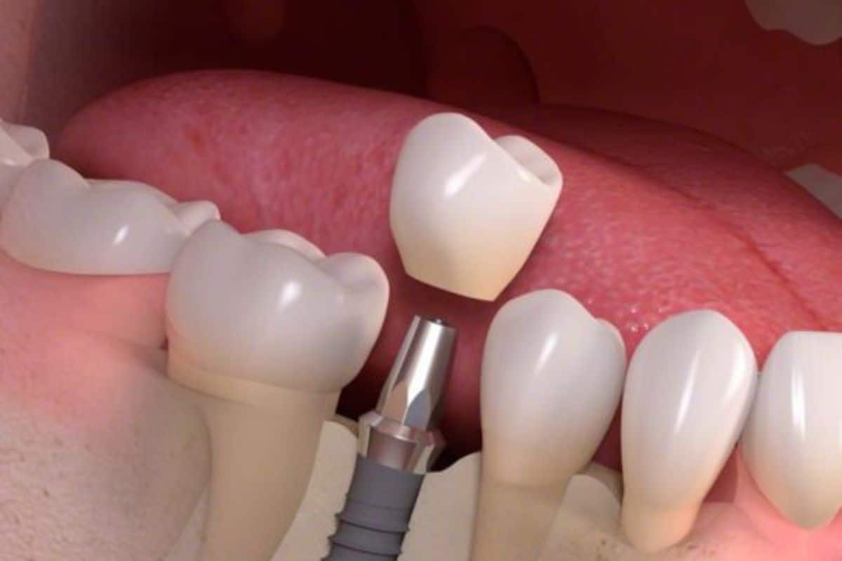Dental Implants Seattle