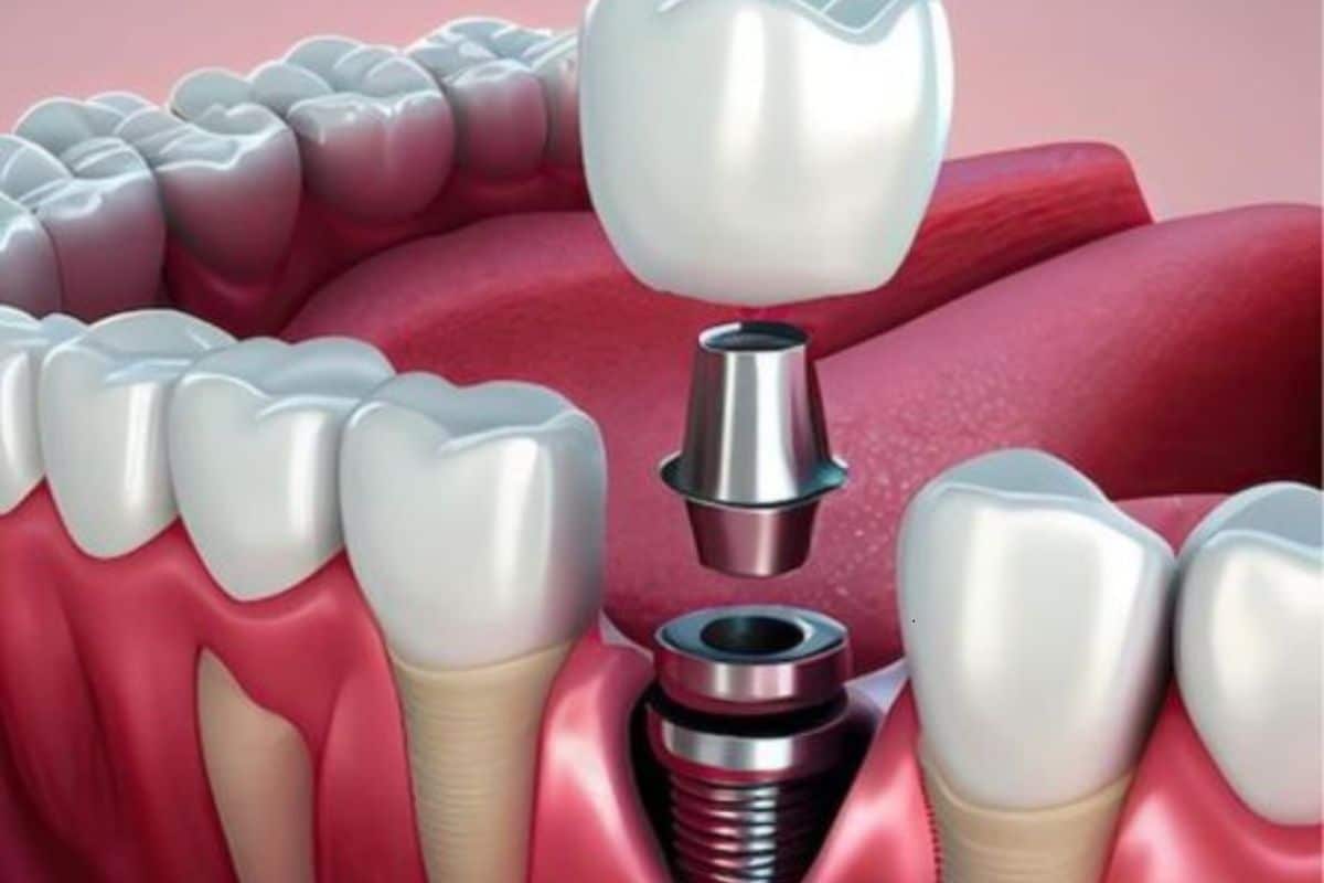 Dental Implants in Seattle