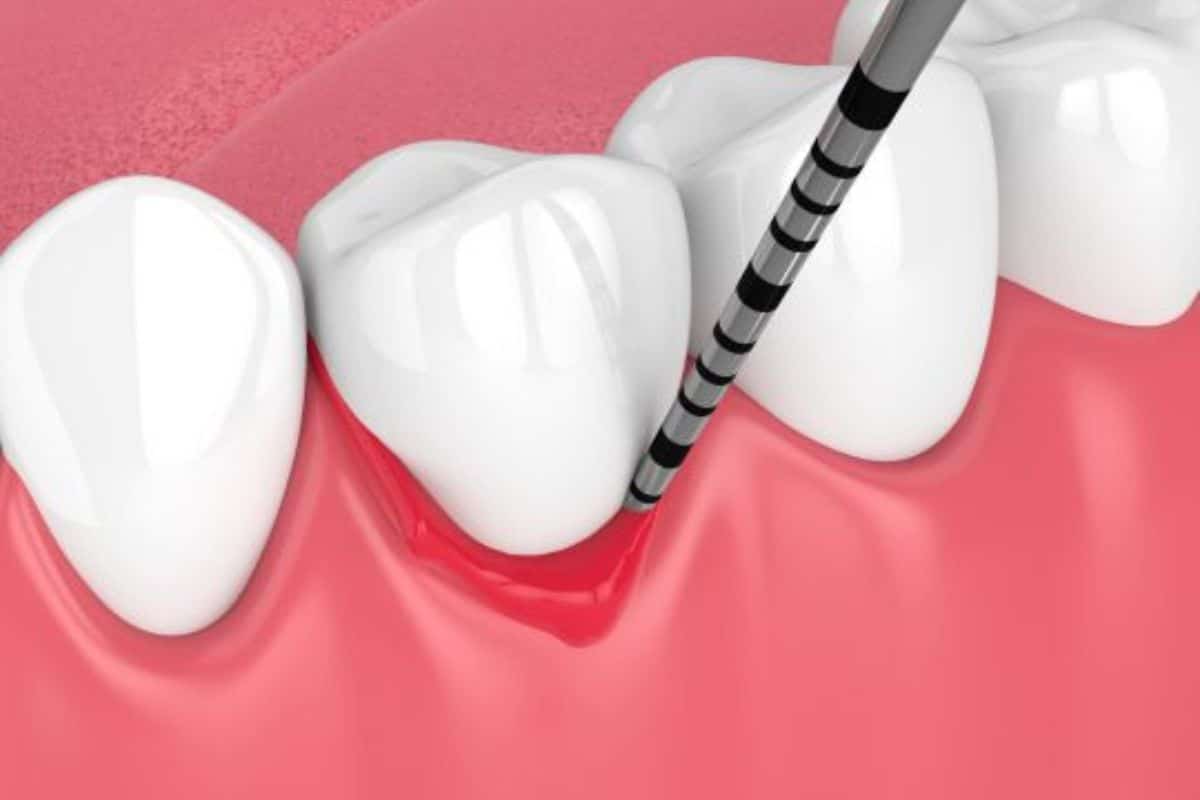 Periodontist in Seattle