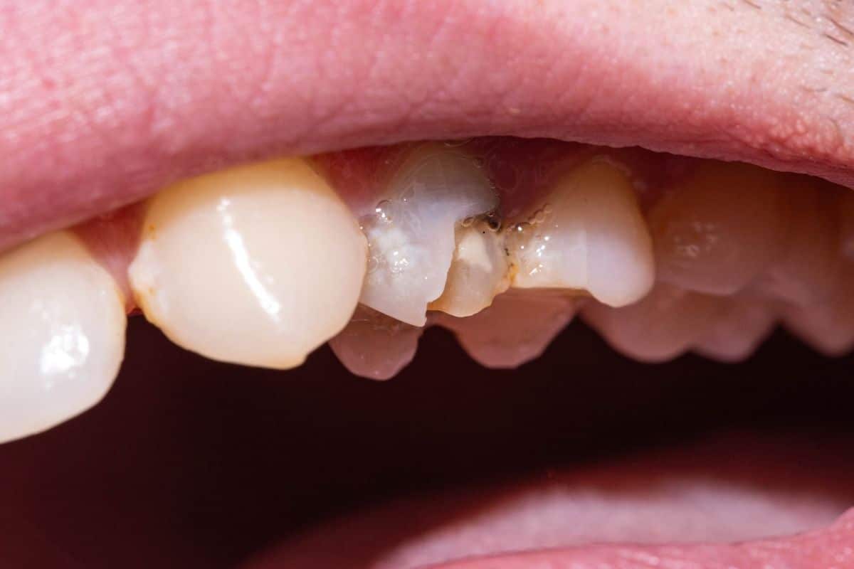dentist Seattle - Fixes a Chipped Tooth