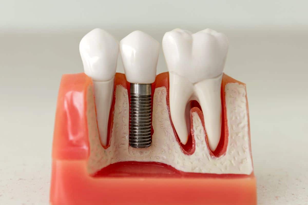 Dental implants in Seattle