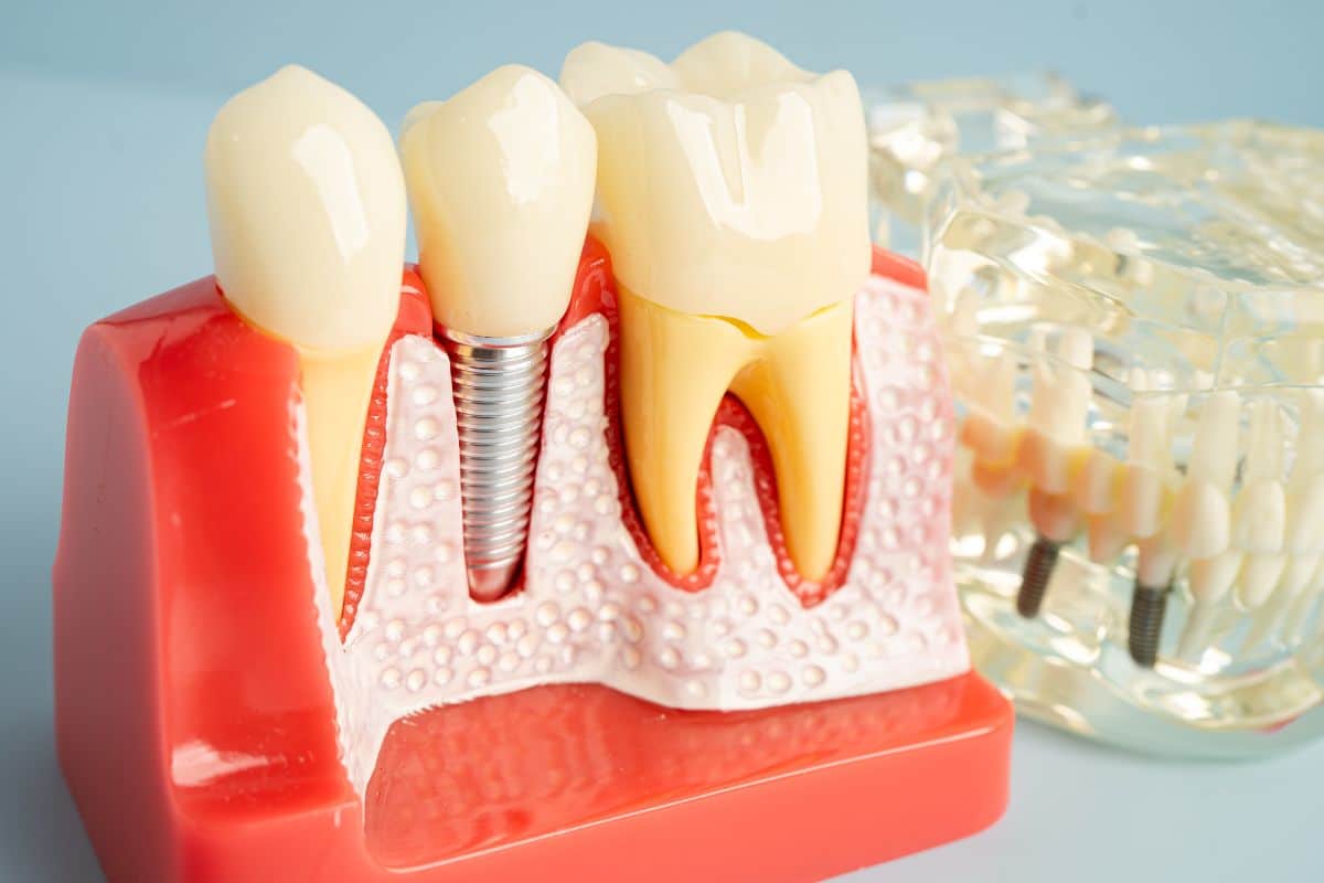 Planning dental implants in Seattle