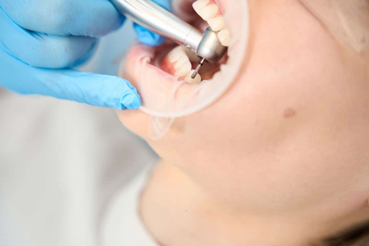 dentist seattle explain the hidden Trio Behind Tooth Decay