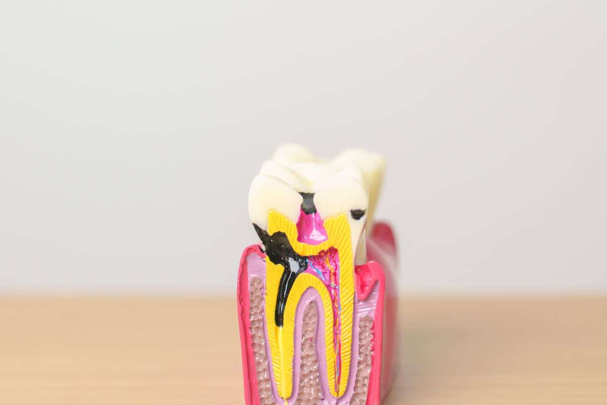 cavity treatment- Seattle dentist