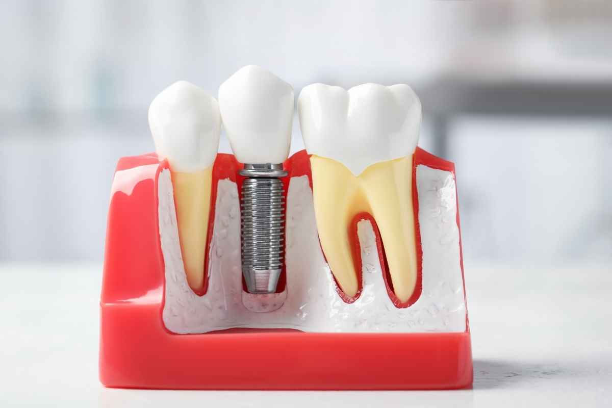 dental implants for missing teeth in Seattle