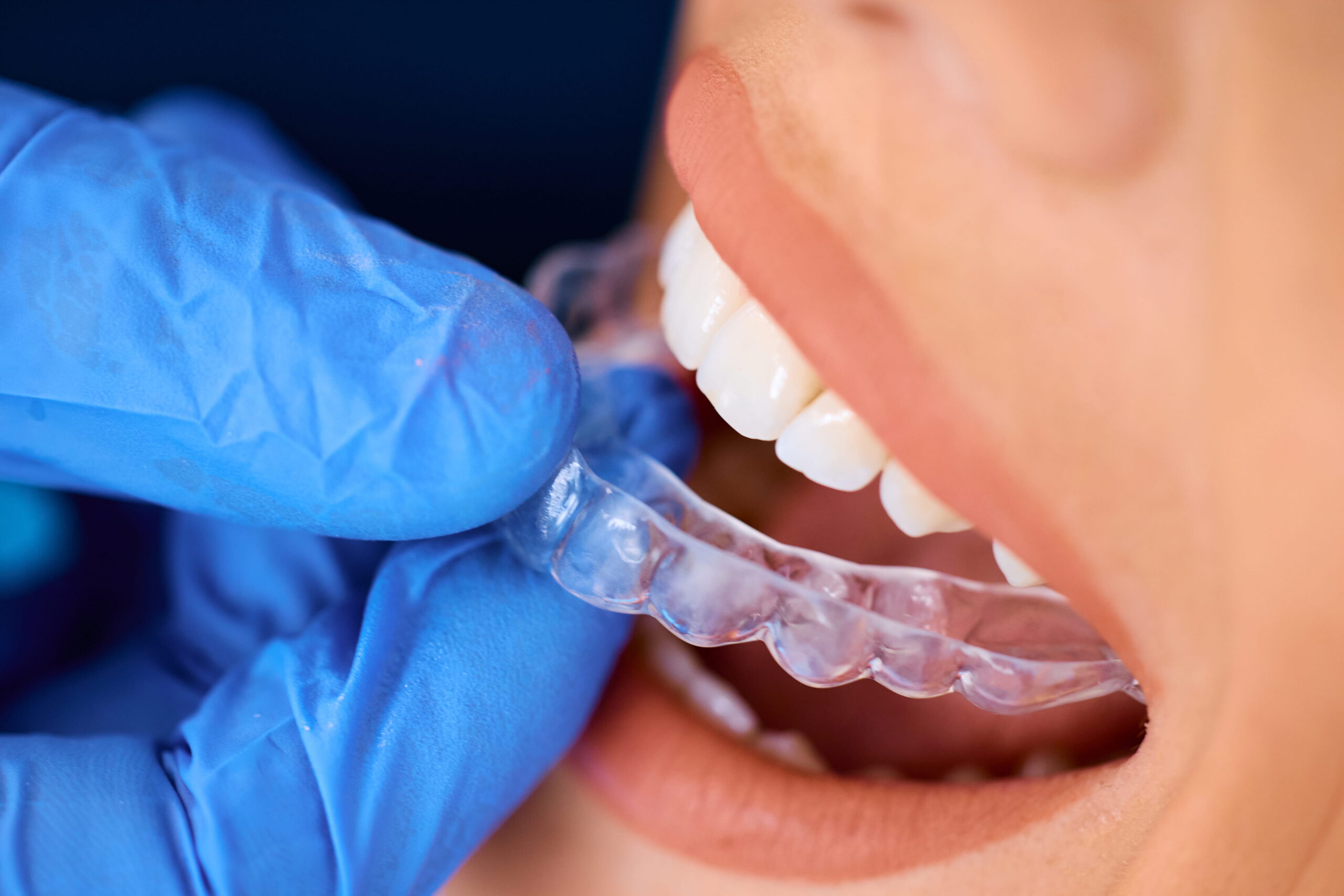 Orthodontic Treatment Cost