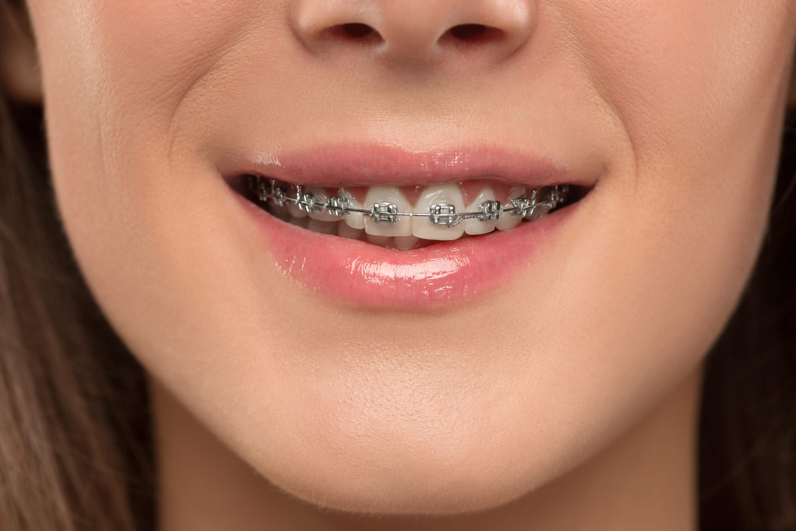 types of braces