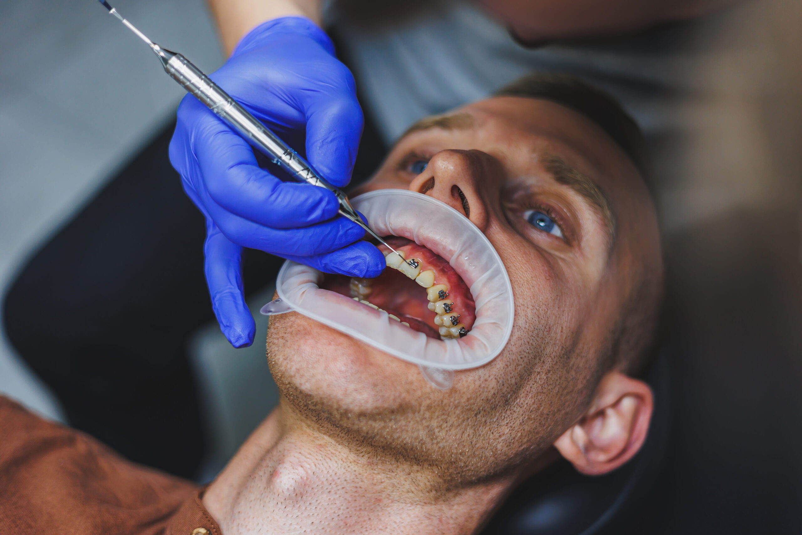 Explain how a mouthguard sits over orthodontic brackets
