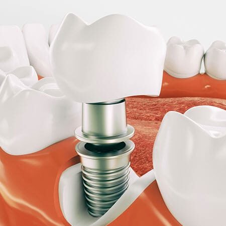 image of a dental implant