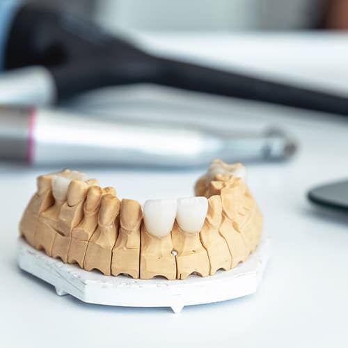 dental implants Seattle